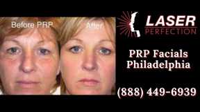 PRP Facials Philadelphia PA Laser Perfection 888 449 6939