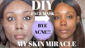 OILY SKIN ACNE CHEAP SKIN CARE ROUTINE!!! REMOVE ACNE/ DARK SPOTS CLEAR SKIN FAST  - Rose Kimberly