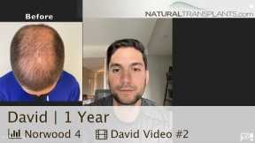 Hair Loss Treatment for Men | 1 Year Hair Transplant Results by Dr. Kevin Blumenthal (David)