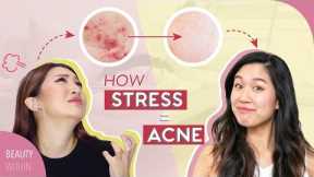 5 Signs + 5 Easy Cures to Prevent ACNE and STRESSED Skin