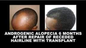 Hair Growth Time-frame After Hair Transplant