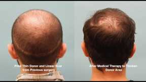 Extracellular Vesicles for Hair Growth - Patient Hair Loss Journey