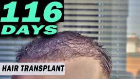 FUE Hair Transplant Day 102 - 116 Istanbul, Turkey TIME LAPSE