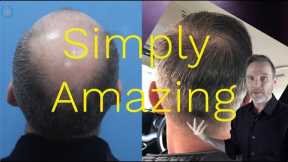 Crown Hair Transplant Results - Eugenix Hair Sciences