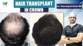 👨🏻👴🏻Hair Transplant in Crown Area ✅ | Best Crown Area Hair Transplant Result in India | MedLinks
