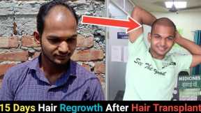 15 Days Hair Regrowth Time Lapse After Hair Transplant In India 2020।