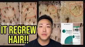 THE BIGGEST BREAKTHROUGH IN HAIR LOSS HISTORY WITH VERTEPORFIN...**UNBELIEVABLE RESULTS**