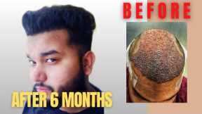 Hair Transplant Journey (SLIDESHOW) | Day 0 to 6 Months | best hair transplant in India 2019