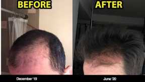 #1 REASON WHY YOU SHOULD BE MICRONEEDLING FOR HAIR LOSS (BEFORE/AFTER PHOTOS)!