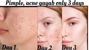 How to remove pimple overnight/3 to 7 days challenge, naturally, acne treatment