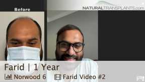 Hair Transplantation Surgery - He Got His Hair Back 1 Year Later | Dr. Blumenthal (Farid)