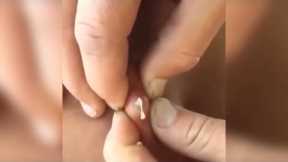 Popping huge blackheads and Pimple Popping - Best Pimple Popping Videos 82