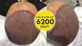 Hair Transplant 6200 Graft