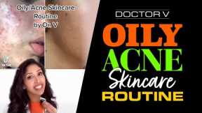 Doctor V - Oily Acne Skincare Routine | Skin Of Colour | Brown Or Black Skin | #shorts