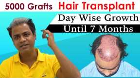 Hair Transplant in India | 5000 Grafts| Day wise Growth until 7 Months | MEDISPA India