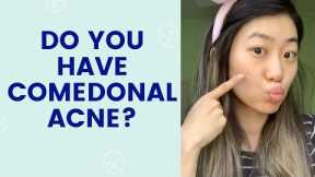Do you have Comedonal Acne? | FaceTory