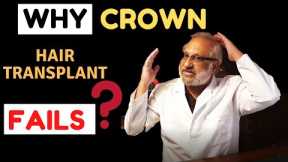 Why CROWN / vertex hair transplants FAIL? | GRADE 6  | India