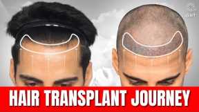 Hair Transplant Time Lapse | Step by Step Hair Transplant Surgery Time Lapse | NW Grade 2 | QHT