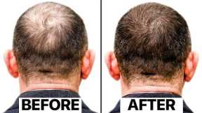 The Truth Behind This New Hair Loss Treatment | Exosomes