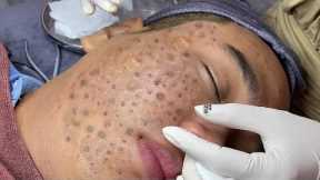 Perfect time every day with Video Popping Tons Of Blackheads