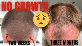 Hair Transplant 3 Months NO GROWTH!