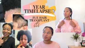 1 Year Time-lapse of my FUE Hair Transplant| Natural Hair