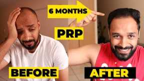 ✅ PRP 6 MONTH RESULTS - 3 PRP sessions | HAIR TRANSPLANT vs PRP which one should you really go for?