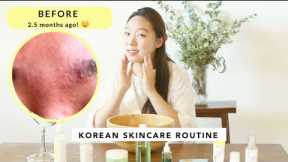 Korean Skincare Routine I ACNE OILY SKIN I HOW TO GET RID OF FUNGAL ACNE,  DARK SPOTS, TEXTURED SKIN