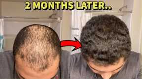 BALD GUY REVERSES HAIR LOSS IN 2 MONTHS! HERE'S WHAT HE DID!
