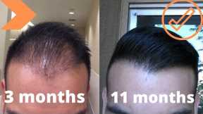 When To Expect Growth After A Hair Transplant *My Timeline