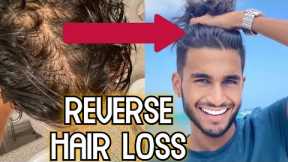 How to Reverse Hair Loss (4 Steps to STOP BALDING)
