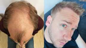 Hair Transplant Before and After - Month by Month results Elithair #8