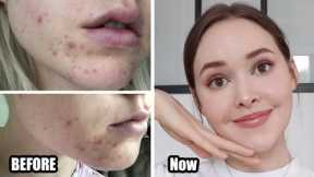How To Really Get Rid Of Acne (& texture/acne scars/skin damage) *Adult Hormonal Acne*