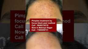 Best Pimples treatment by focus black peel method at skinaa clinic | Viral #shorts