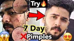 3 Tips For Pimple Free Clear Skin | Remove Pimple and acne, Pimple Mistakes #shorts #skincare