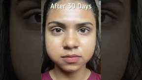 My skincare routine and acne  transformation in just 30 days #skincare #shorts #acnetreatment #acne