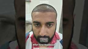 Hair Transplant Journey To Look Normal - Call 08376927927 #shorts #hairtransplant #hairloss #short