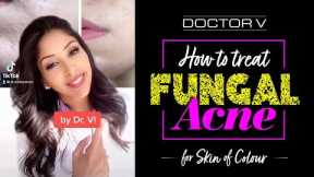 Doctor V - How To Treat Fungal Acne For Skin Of Colour | Brown Or Black Skin | #shorts