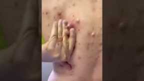 pimple popping 2022 new, blackheads on nose, pimple popping tiktok #4523rww