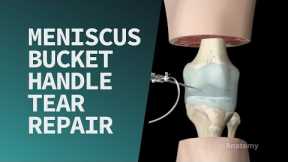 Meniscus Bucket Handle Tear Repair