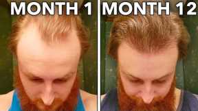 How I Grew Back My Receding Hairline In 12 Months