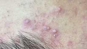 Cystic Blackheads Extraction New This Week #sacdepspa