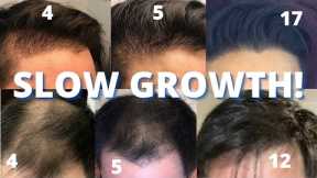 Hair Transplant Slow Growers Watch THIS!