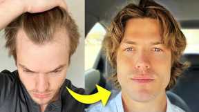 My Turkey Hair Transplant Results After 1 Year | Before & After