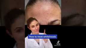 How to treat whiteheads #Shorts