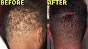 DESTROYED Donor Area RESURRECTED With MORE Hair Grafts!! **UNBELIEVEABLE**