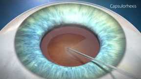 Cataract Surgery  Animation