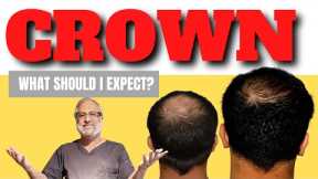 Hair transplant result for  Crown & Vertex | Before and after Video by Dr Bhatti