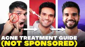 PIMPLE pe thook mat bro! Acne Treatment Guide | How To Remove Acne | BeYourBest Skincare San Kalra