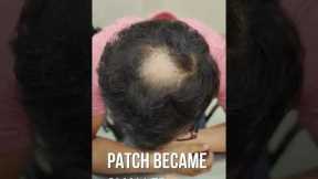 Treating Alopecia Areata to get full hair growth!